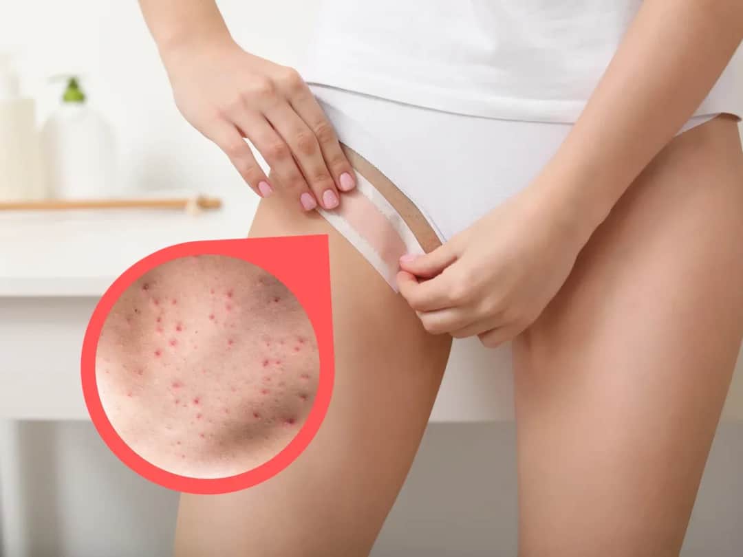 Jak pozbyć się krost po goleniu bikini i uniknąć podrażnień