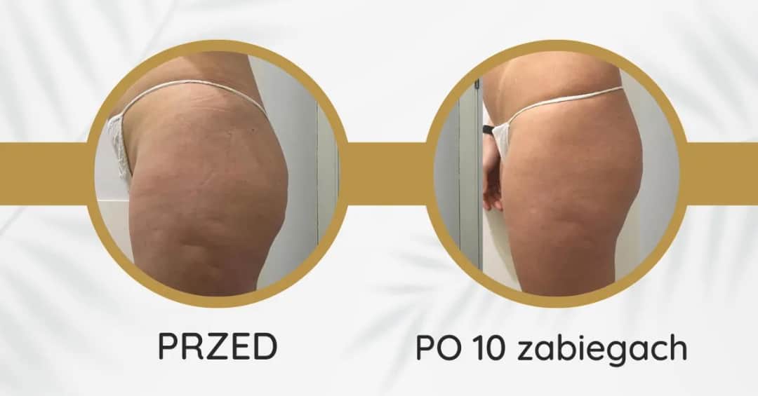 Endermologia czy działa? Sprawdź skuteczność i efekty zabiegu
