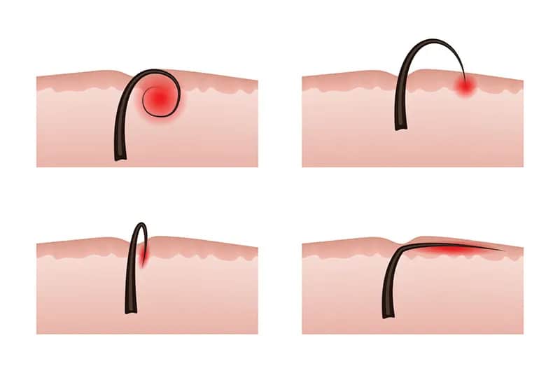 Depilacja brazylijska co to? Poznaj metody, ból i przygotowanie