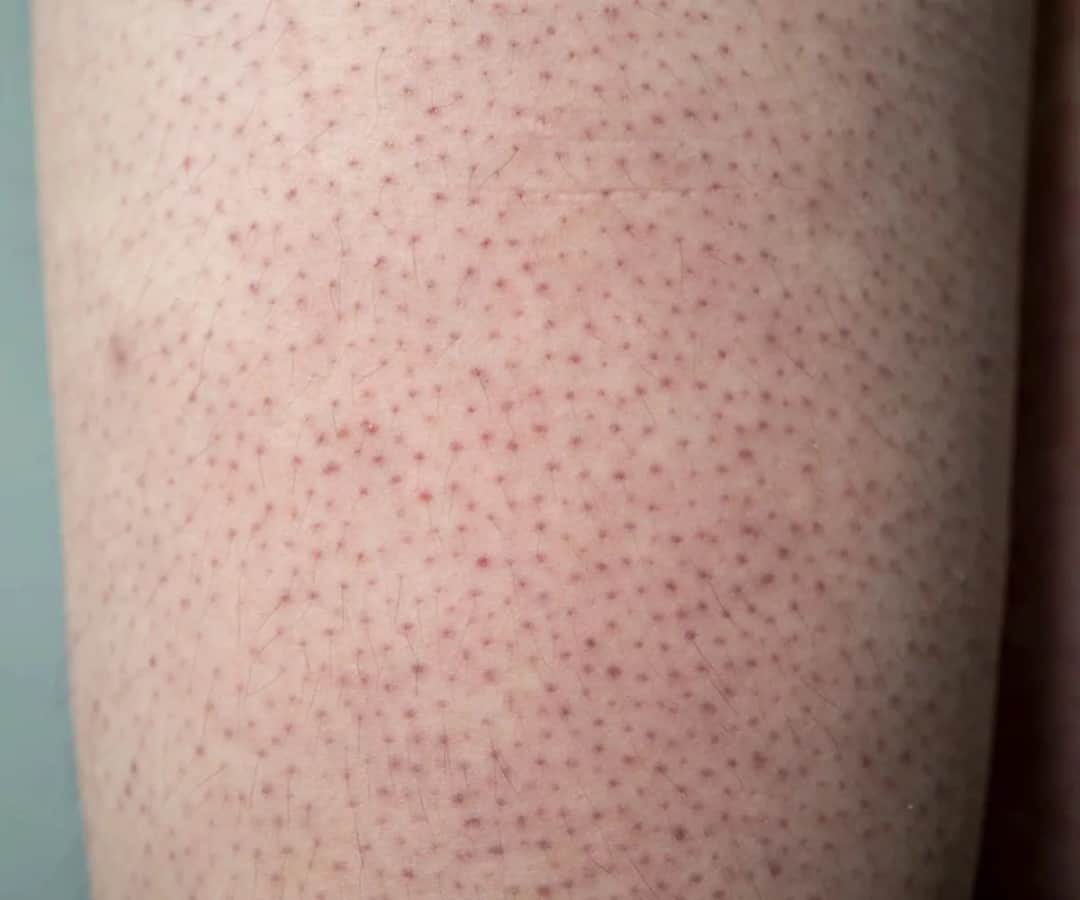 Jak skutecznie pozbyć się truskawkowych nóg i poprawić ich wygląd