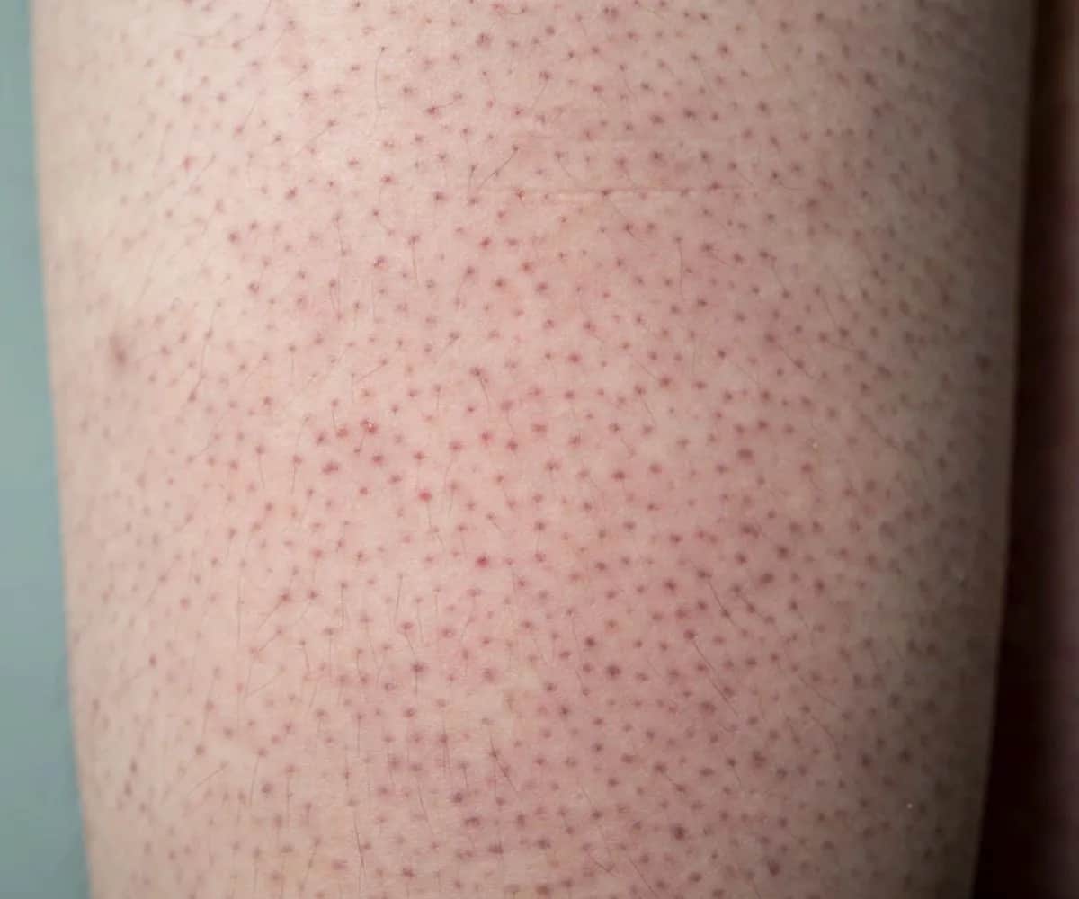 Jak skutecznie pozbyć się truskawkowych nóg i poprawić ich wygląd