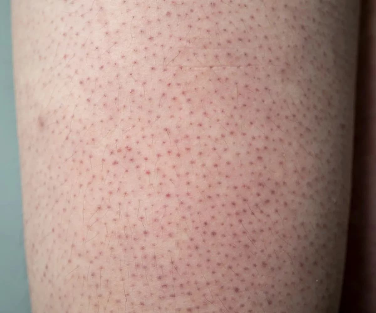 Jak skutecznie pozbyć się truskawkowych nóg i poprawić ich wygląd