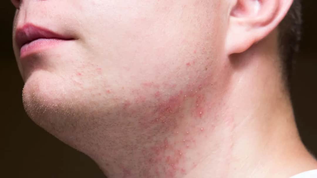 Czym smarować podrażnienia po goleniu, aby szybko złagodzić ból?