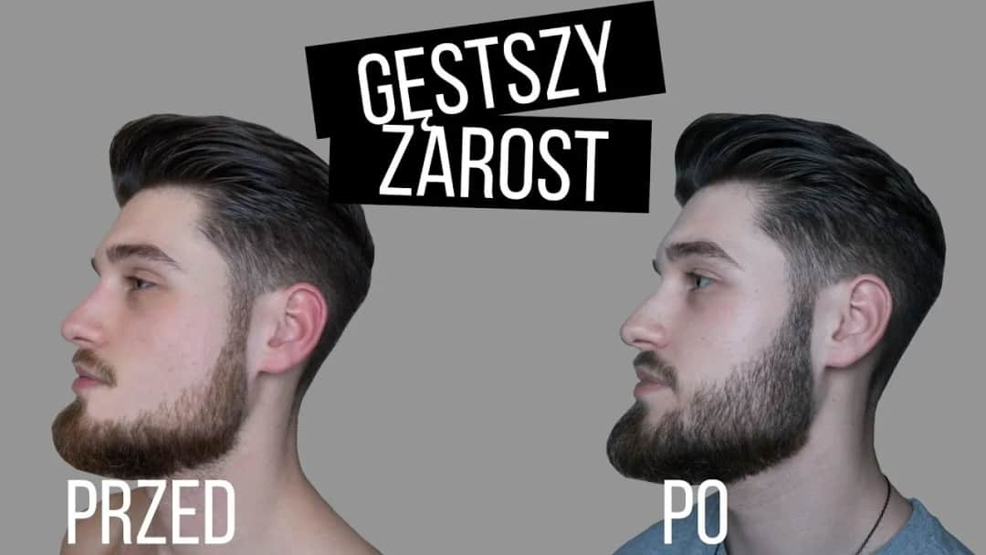 Jak zagęścić zarost na policzkach i uniknąć rzadkiego owłosienia