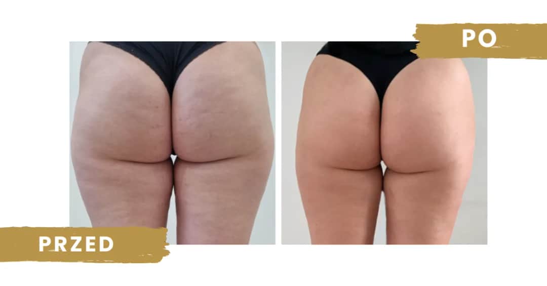 Co daje endermologia? Efekty, które mogą Cię zaskoczyć