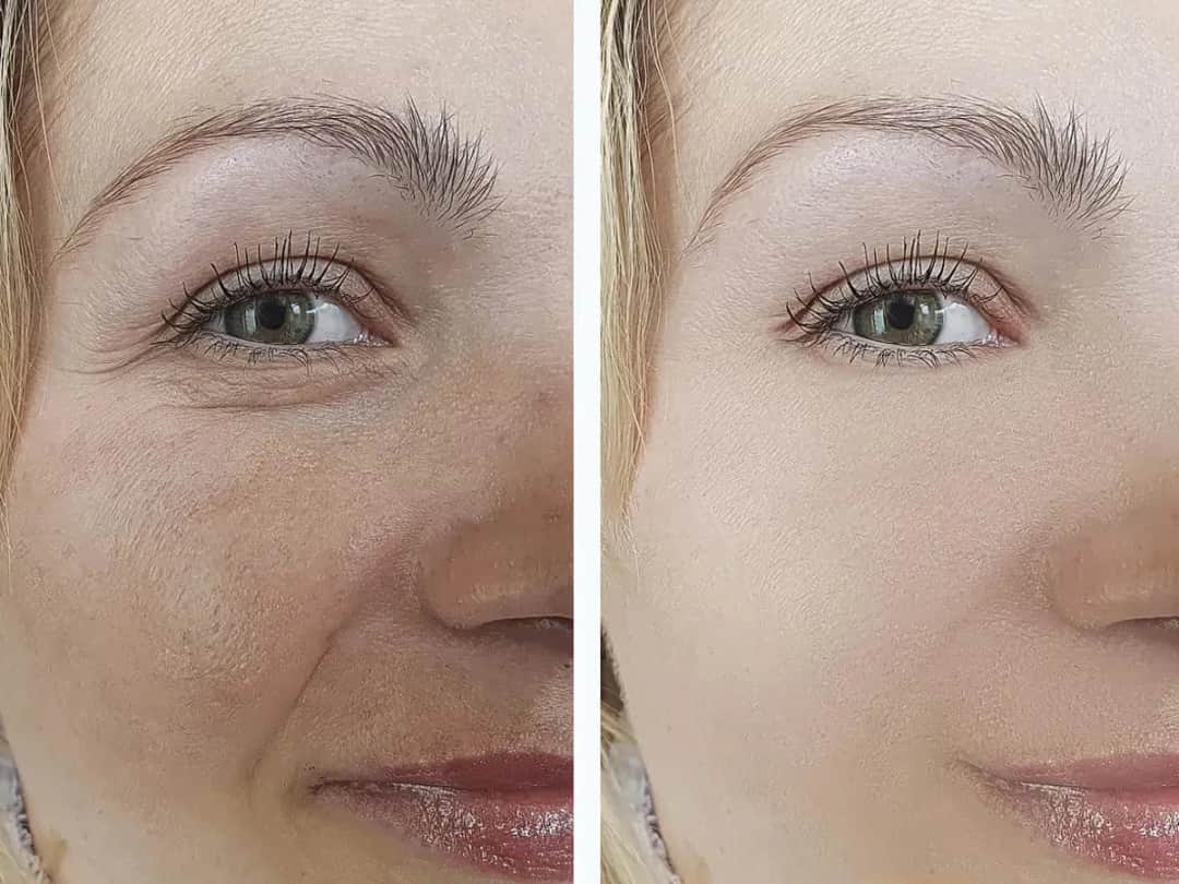 Jak długo utrzymuje się efekt po mikrodermabrazji? Odkryj prawdę!