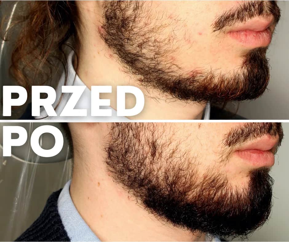 Jak zwiększyć zarost na twarzy - skuteczne sposoby na gęstość i zdrowie