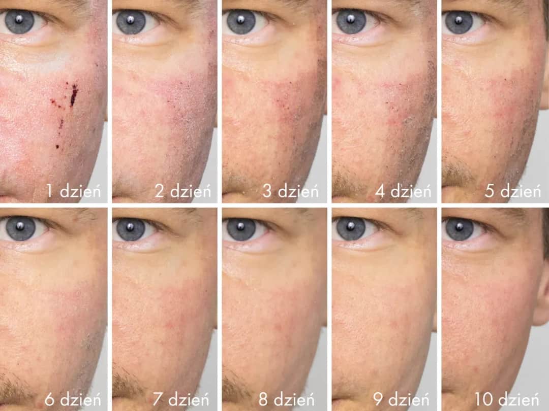 Kiedy widać efekty po laserze frakcyjnym? Oczekiwane rezultaty i czas