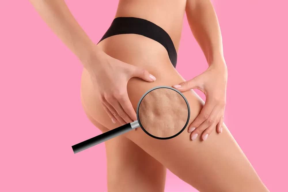 Skuteczne sposoby na usunięcie cellulitu z pośladków i poprawę skóry
