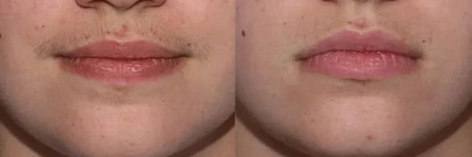 Ile kosztuje depilacja laserowa wąsika? Porównaj ceny i oferty