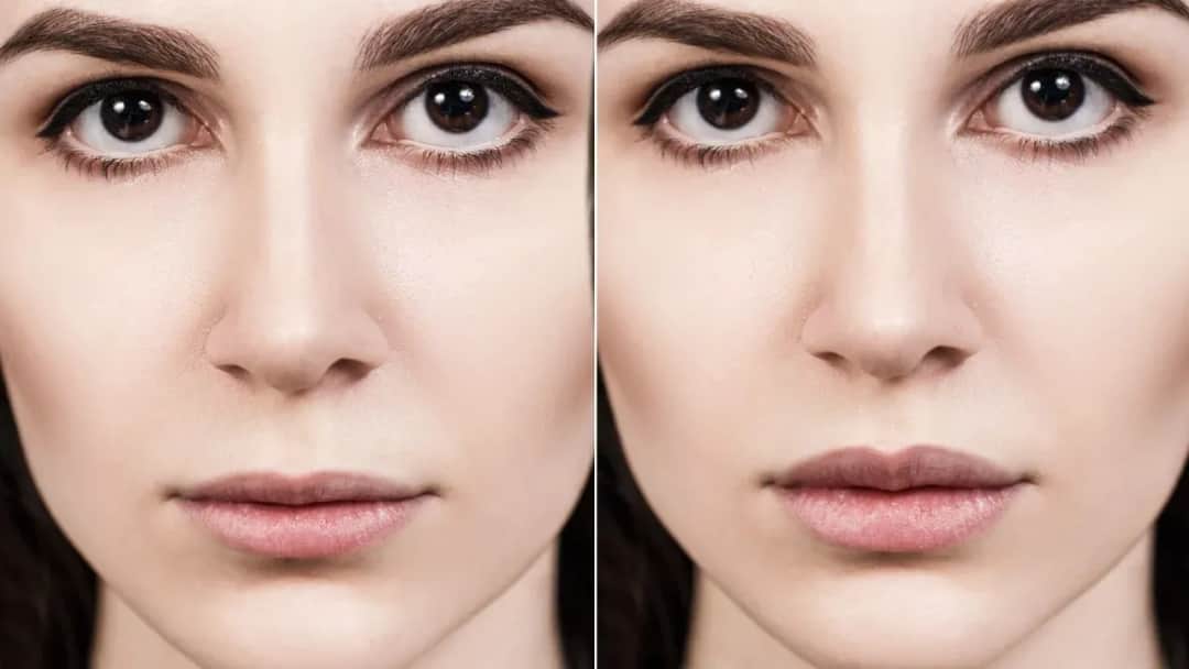 Usta: botoks czy kwas hialuronowy - co wybrać dla idealnego efektu?