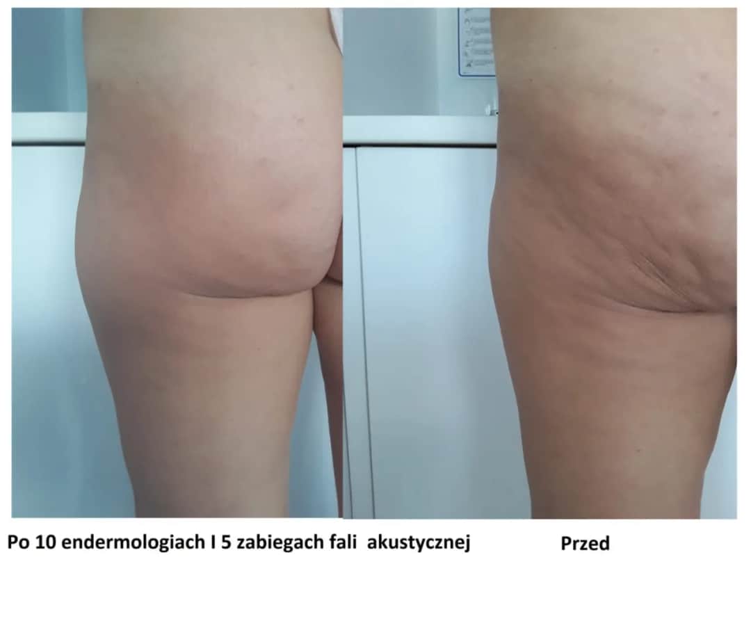 Jak pozbyć się cellulitu w ciąży - bezpieczne metody na skuteczną redukcję