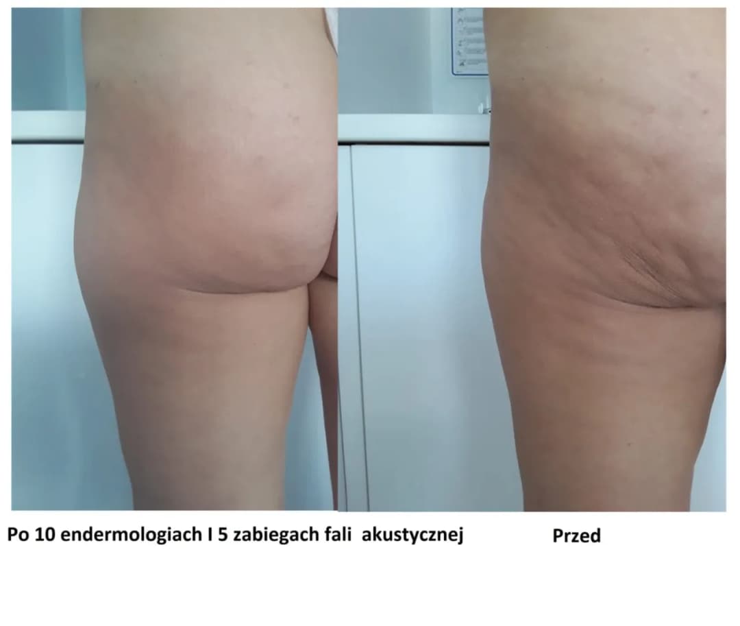 Jak pozbyć się cellulitu w ciąży - bezpieczne metody na skuteczną redukcję