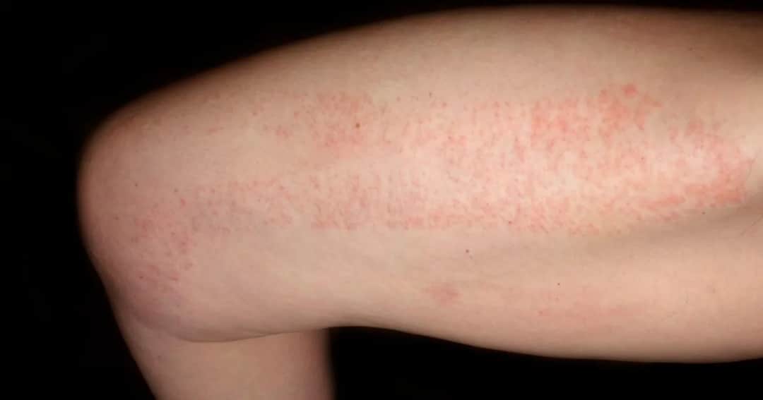 Czerwone kropki po goleniu: przyczyny i skuteczne sposoby na ulgę