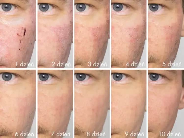 Laserowe wygładzanie zmarszczek - skuteczne metody i efekty zabiegu