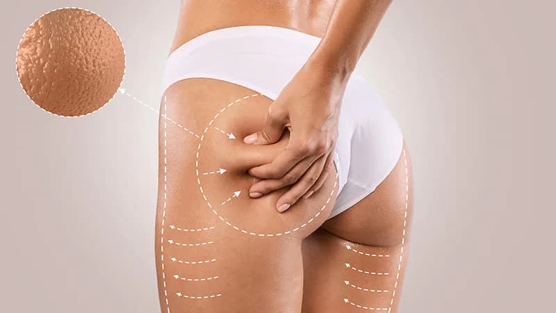 Do jakiego lekarza z cellulitem? Sprawdź, kto skutecznie pomoże