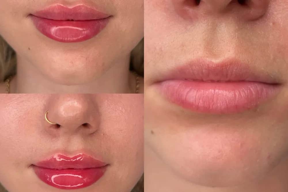 Czy powiększanie ust kwasem hialuronowym jest bezpieczne? Odkryj ryzyka